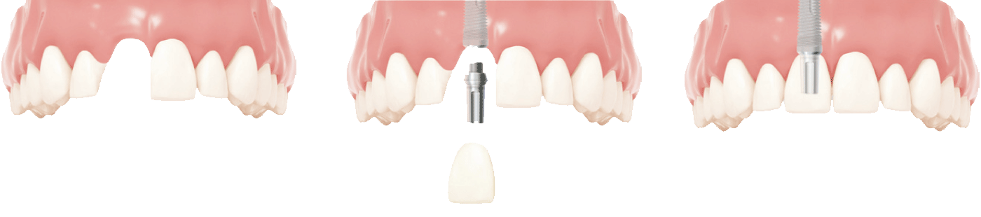Rekonstrukcja braku pojedynczego zęba na implancie